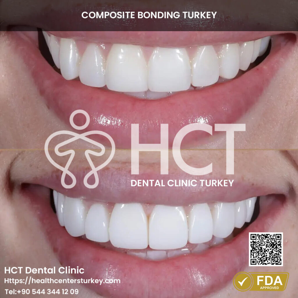 composite bonding results