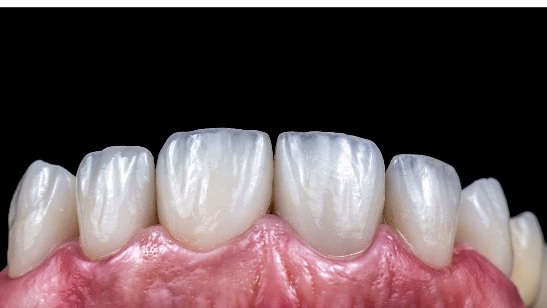 Zirconium vs E-Max Veneers Turkey: The Ultimate Material Comparison 1 e-max veneers turkey