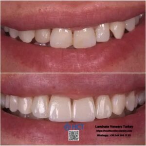 Laminate Veneers Turkey 8 Laminate Veneers Turkey is a preferred choice for enhancing smiles with Laminate Teeth.