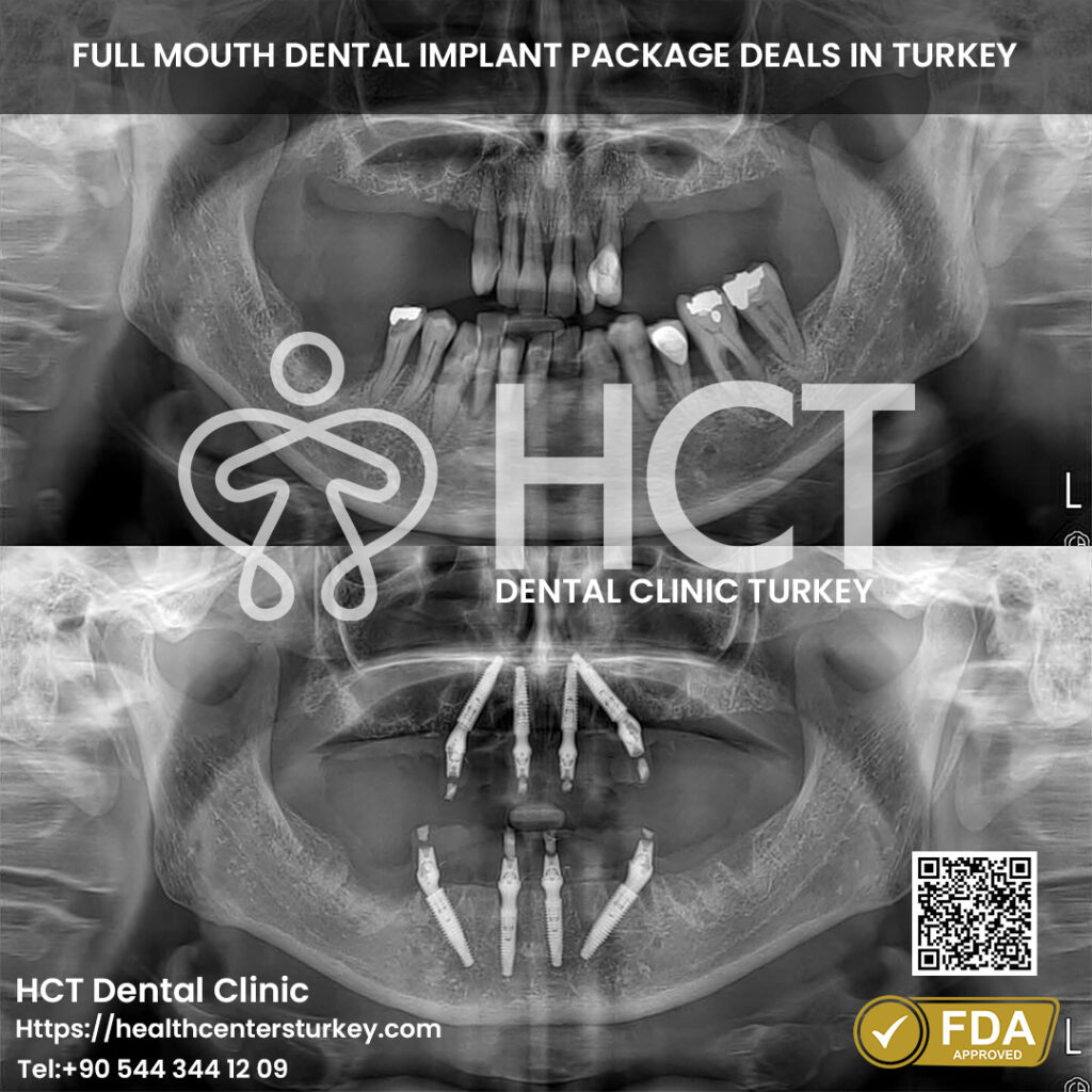 Full Mouth Dental Implants in Turkey 25 All-on-4 dental implants Turkey affordable package deals for full mouth reconstruction