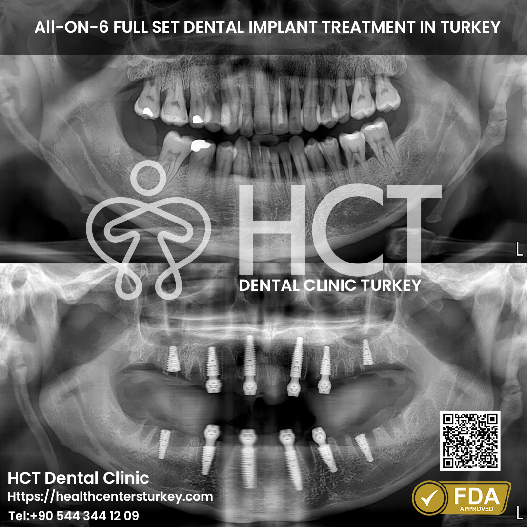 All on 6 Dental Implant in Turkey 10 all on 6 dental implants package deals turkey before after picture from best dental clinic in Turkey HCT Dental Clinic