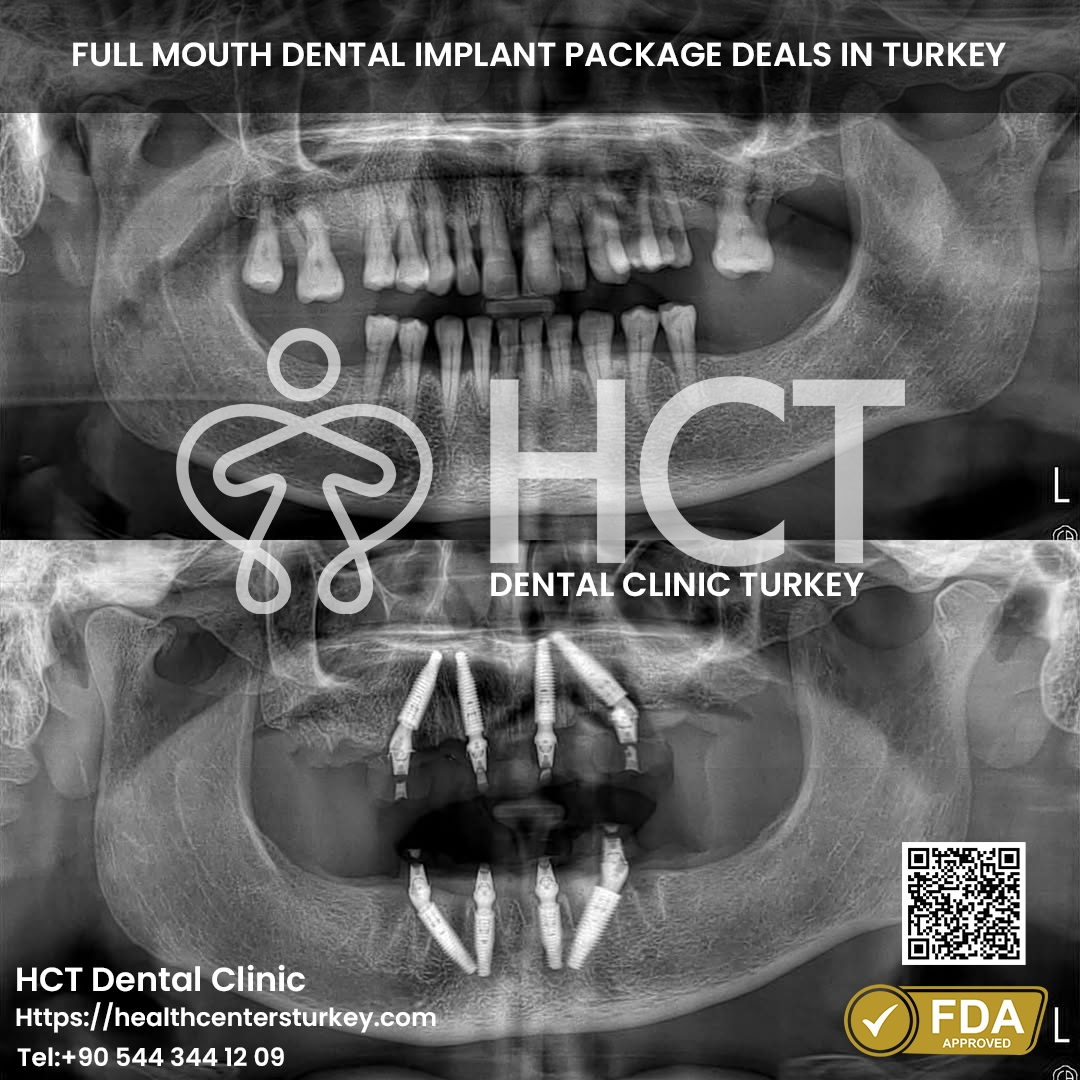 All on 6 Dental Implant in Turkey 16 Full mouth All-on-4 dental implants Turkey reviews and results