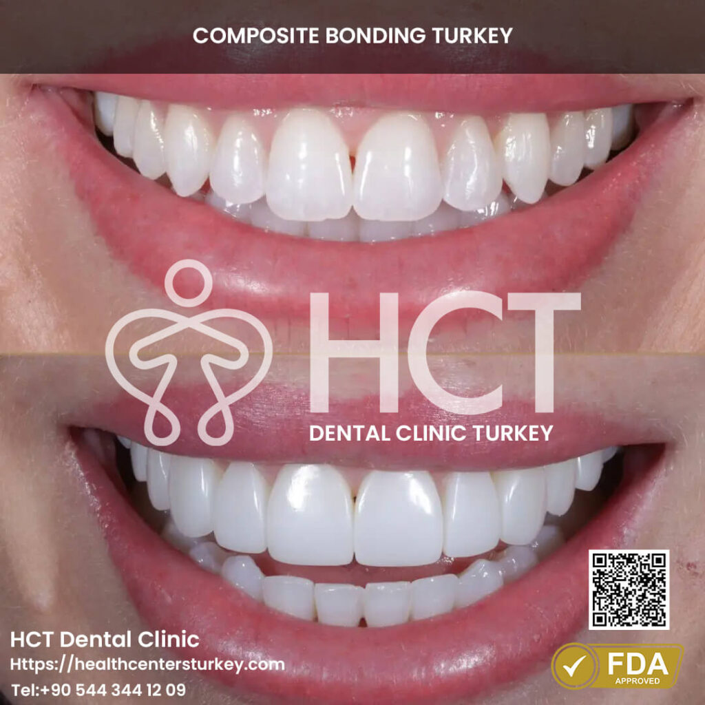 Composite Bonding Turkey Cost - Benefits - Package Deals 10 Fix tooth discoloration with composite bonding treatments.