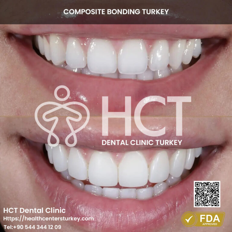 Get Hollywood Smile In Turkey 12 Chipped teeth before and after composite bonding, showing remarkable restoration.