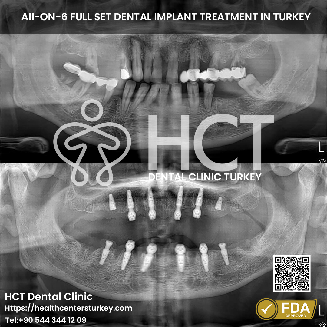 All on 6 Dental Implant in Turkey 6 Panoramic X-Ray Before and After All-on-6 Dental Implants in Turkey