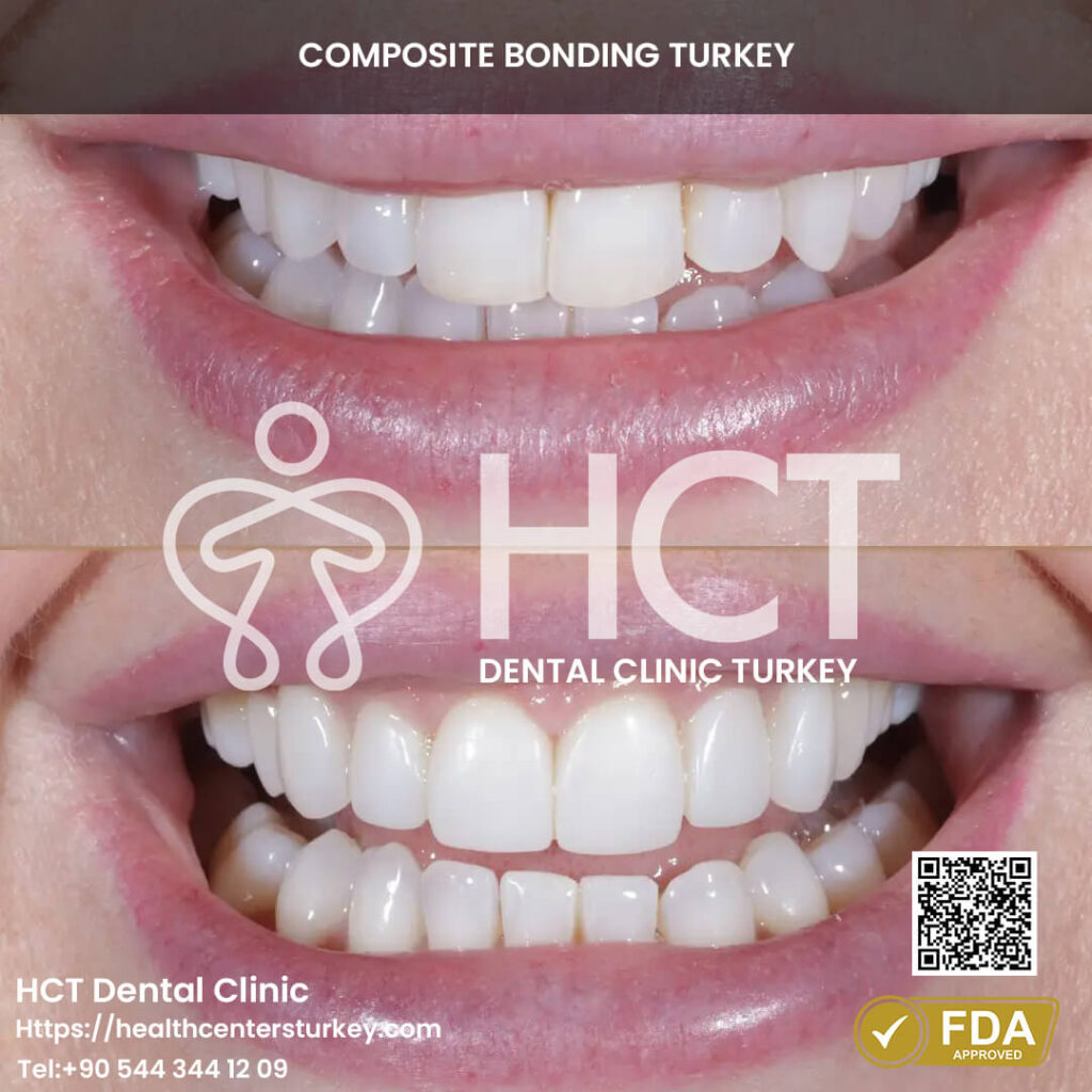Composite Bonding Turkey Cost - Benefits - Package Deals 6 Composite bonding for repairing cosmetic dental imperfections.