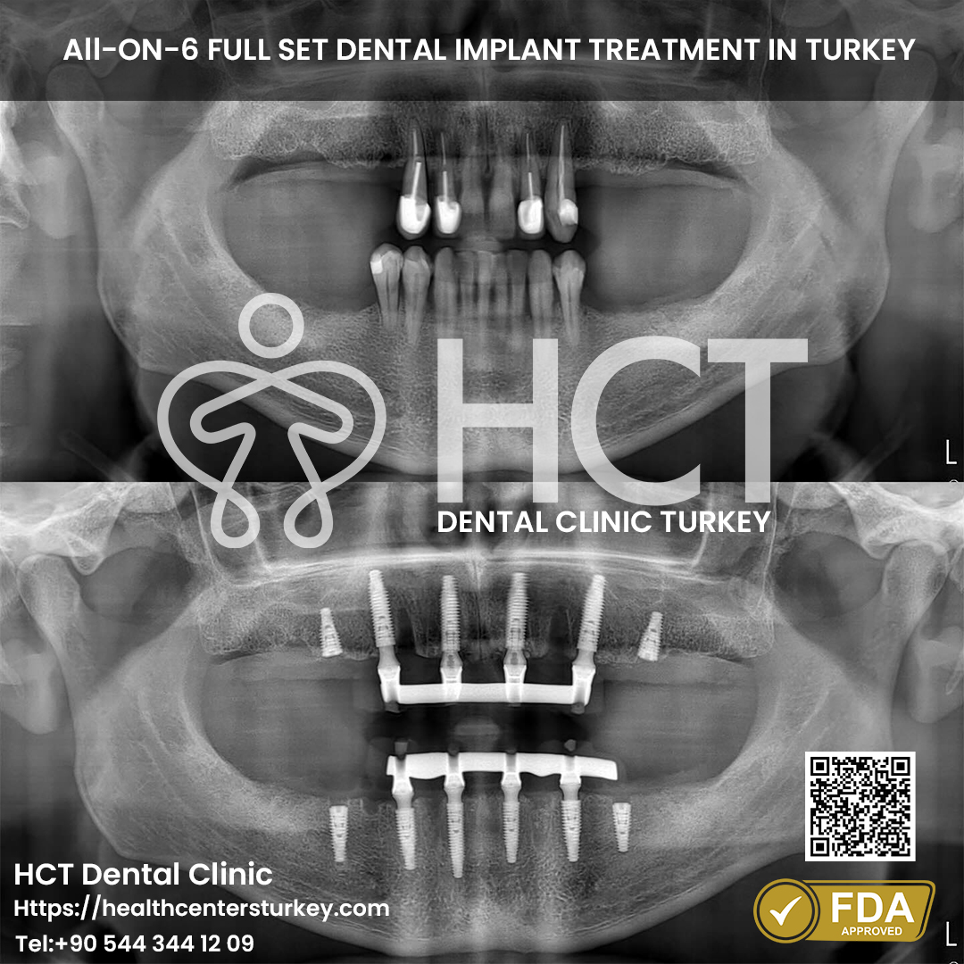 All on 6 Dental Implant in Turkey 8 full set all on 6 dental implant turkey package deals x-ray before after picture from HCT Dental Clinic