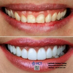 Laminate Veneers Turkey 4 Laminate Veneers Turkey delivers a radiant and confident smile using Laminate Teeth.