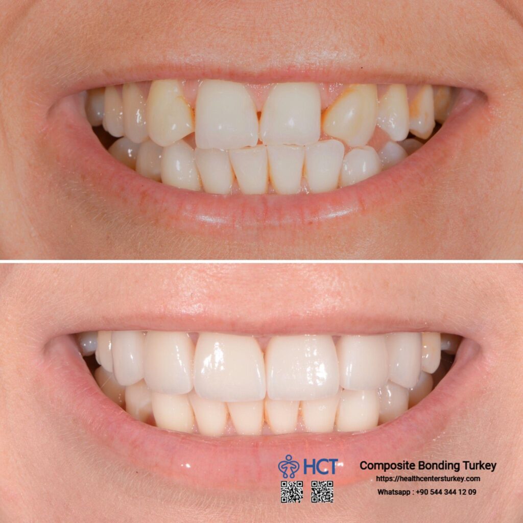 Enhance Your Smile with Cosmetic Dentistry in Turkey