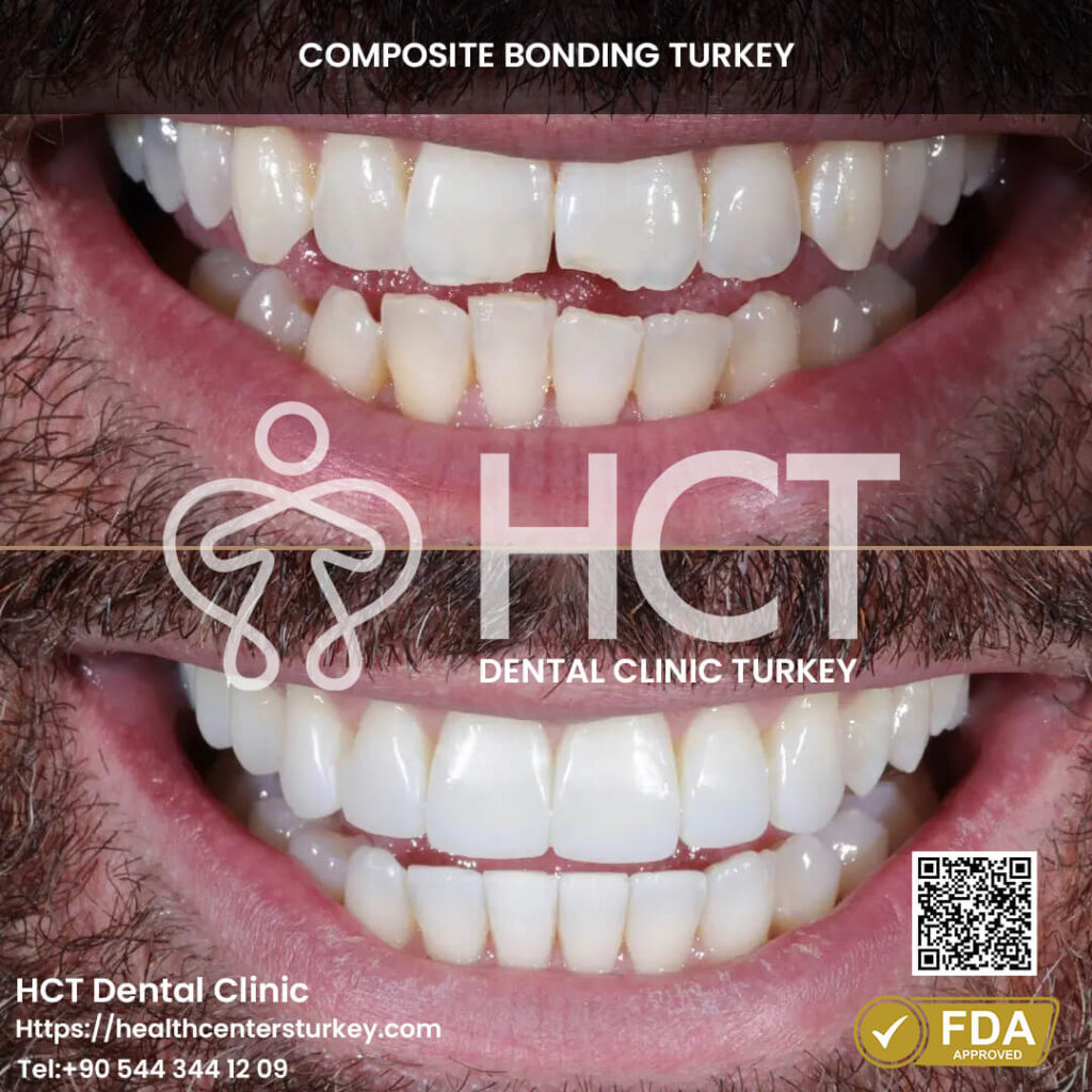 Composite Bonding Turkey Cost - Benefits - Package Deals 7 Correct overlapping teeth with composite bonding.