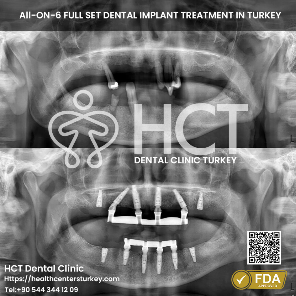 Full Mouth Dental Implants in Turkey 18 full mouth dental implant turkey package deals full set all on 6 both jaw before after x-ray picture