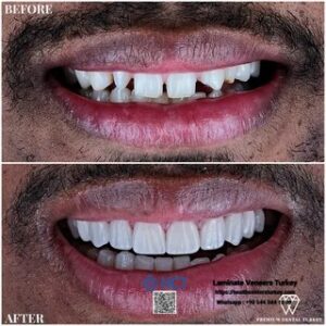 Laminate Veneers Turkey 5 Laminate Veneers Turkey provides a cost-effective option for cosmetic enhancements with Laminate Teeth