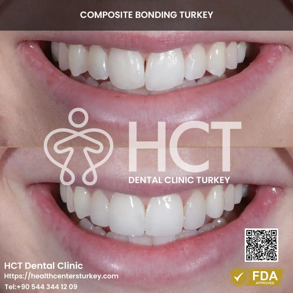 composite bonding results