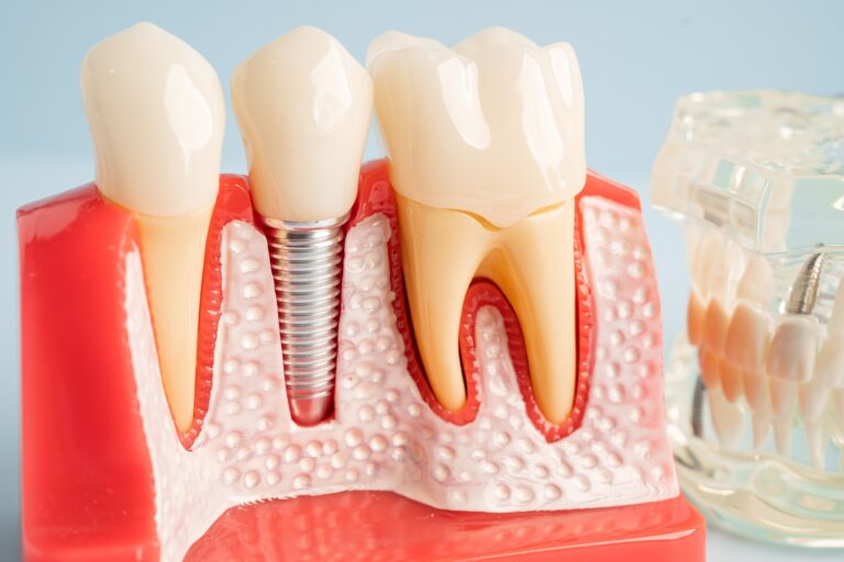 Single Tooth Implant in Turkey 2 a model of teeth with a dental implant
