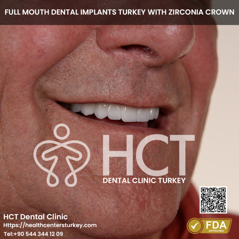 Smile Makeover Turkey 5 full set dental implants turkey package deals turkey final result.