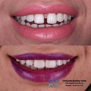 Composite Bonding Turkey Packages: Istanbul & Antalya Costs 46 Composite Bonding Turkey - Restoring dental aesthetics and oral health with expert bonding solutions in Turkey.