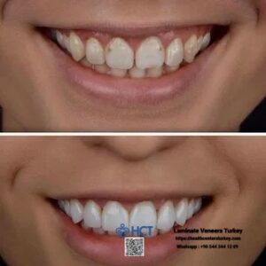 Laminate Veneers Turkey 17 Laminate Veneers Turkey ensures a long lifespan with proper care for Laminate Teeth.
