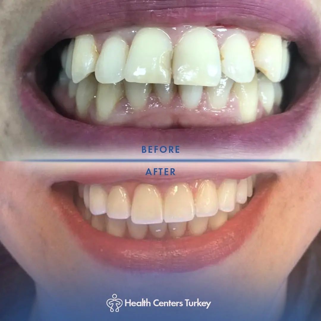 Showcasing the Top-Rated Dental Solutions in Turkey for Beautiful Smiles