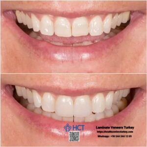 Laminate Veneers Turkey 15 Laminate Veneers Turkey guarantees patient satisfaction with expertly tailored Laminate Teeth.