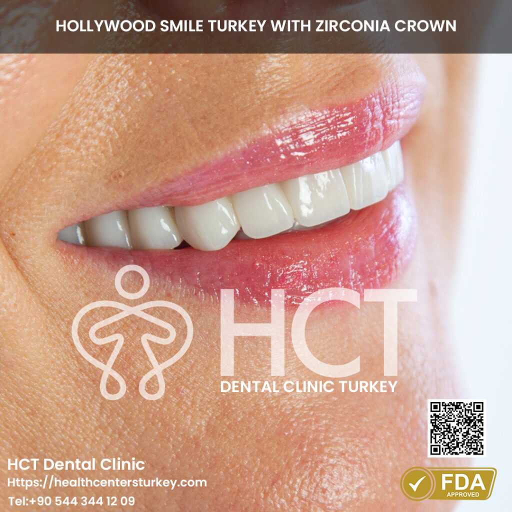 Full Mouth Dental Implants in Turkey 11 Smile makeover with dental implants turkey package deals final result