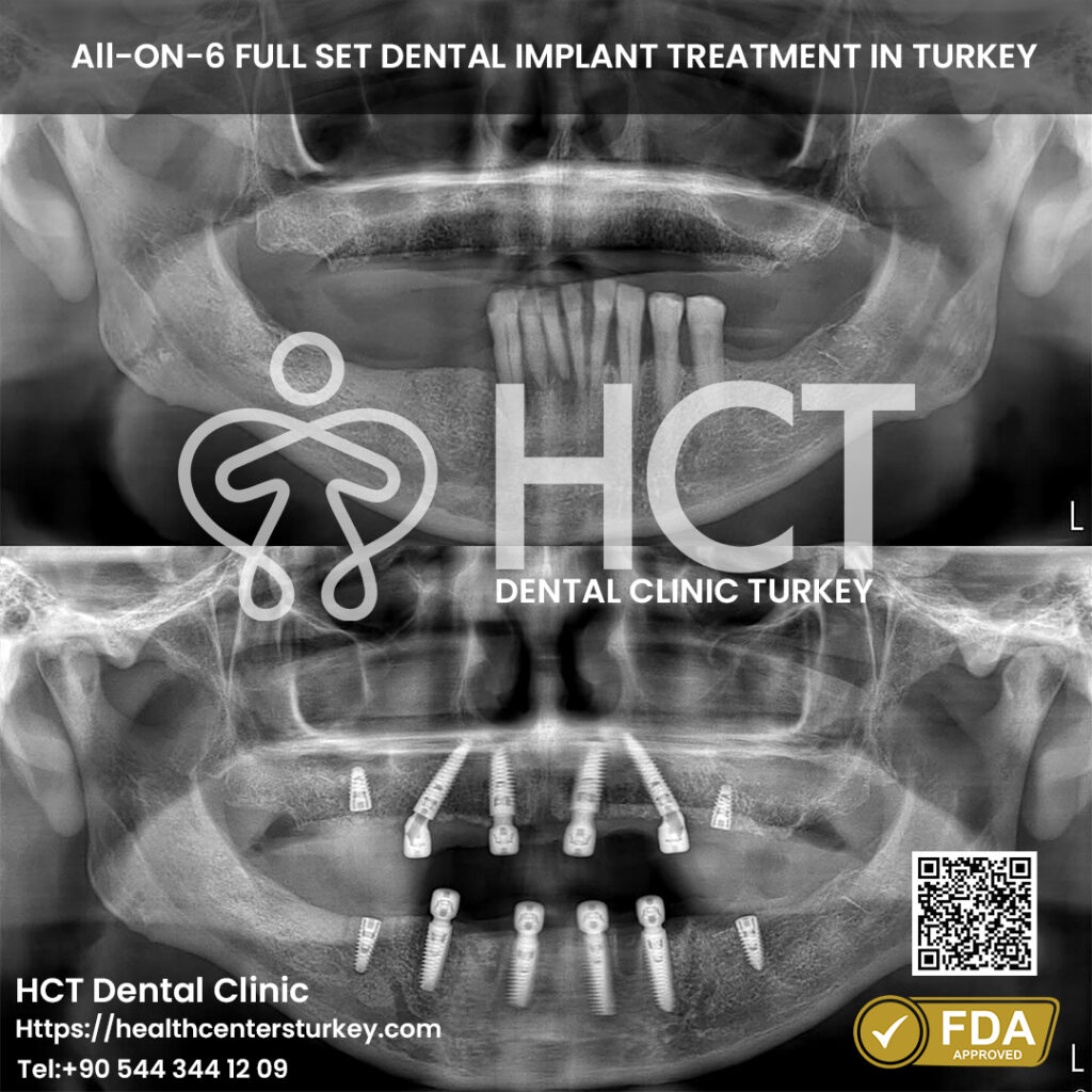 Full Mouth Dental Implants in Turkey 20 affordable full mouth dental implants turkey package deals before after x-ray in Turkey HCT Dental Clinic
