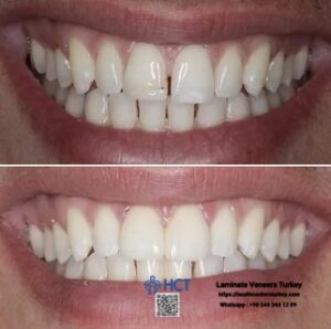 Laminate Veneers Turkey 10 Laminate Veneers Turkey transforms discolored or chipped teeth into radiant Laminate Teeth.