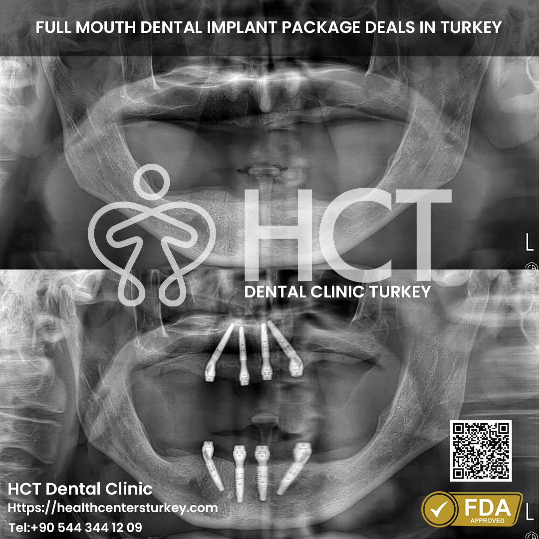 All on 6 Dental Implant in Turkey 13 All-on-4 dental implants Turkey before and after results with patient reviews