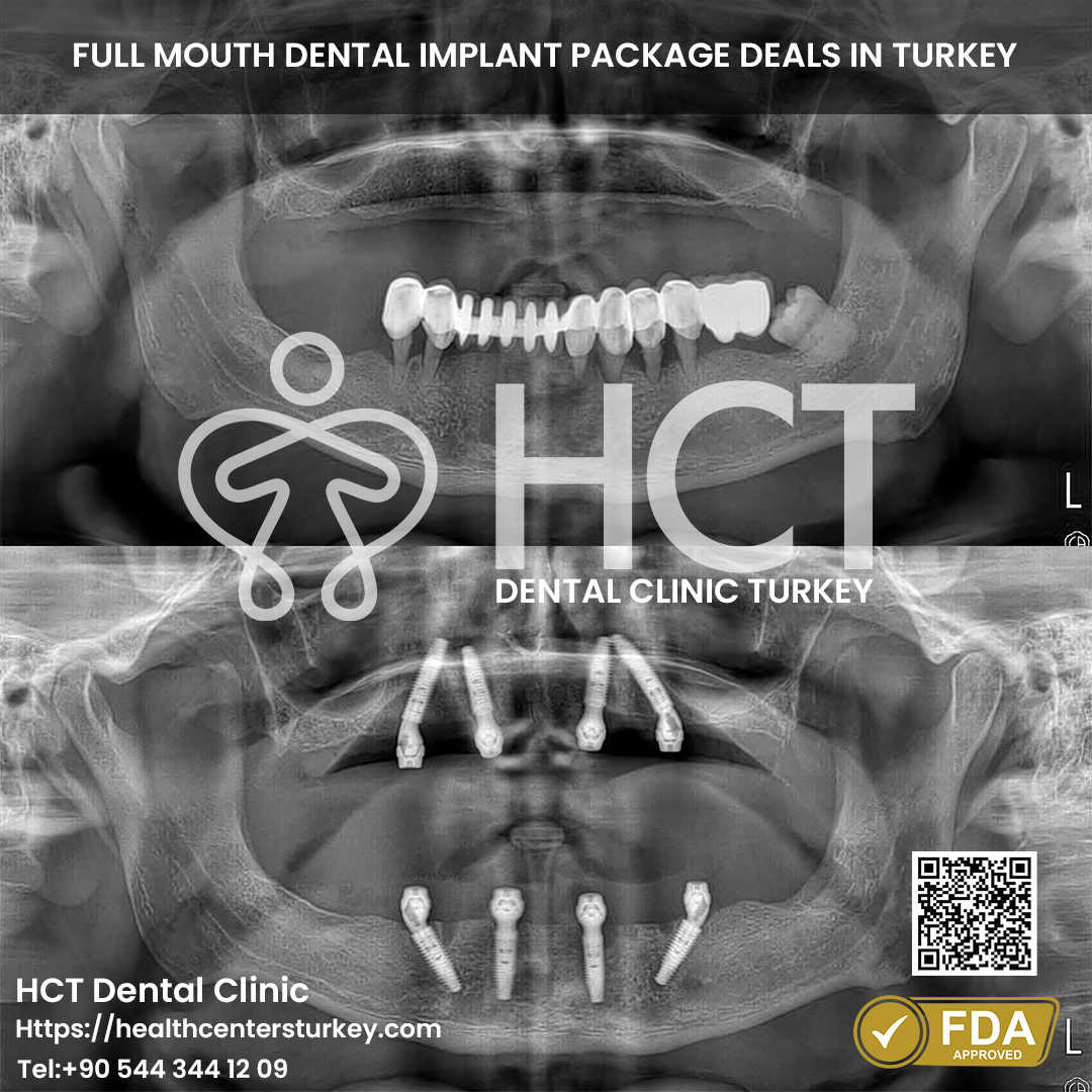 All on 6 Dental Implant in Turkey 3 All-on-4 dental implants Turkey price and patient reviews for full mouth restoration