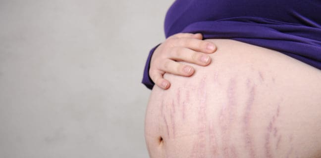 Schwangerschaftsstreifen vorbeugen – Begleiterscheinungen Deiner Schwangerschaft Schwangerschaftsstreifen