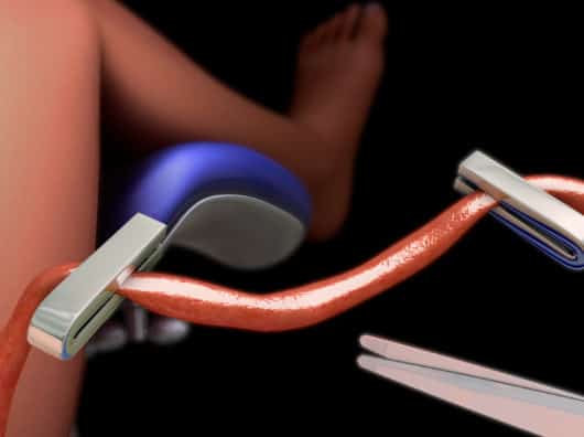 Nabelschnurblut-Banking: Was Eltern wissen müssen newborn umbilical cord cutting