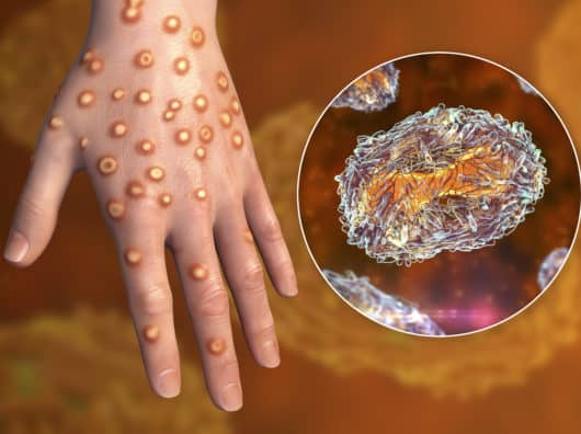 What is Monkeypox and How Do You Protect Yourself? Zoonosene:Hand of a patient with monkeypox infection, 3D illustration. Monkeypox is a zoonotic virus from Poxviridae family, causes monkeypox, a pox-like disease