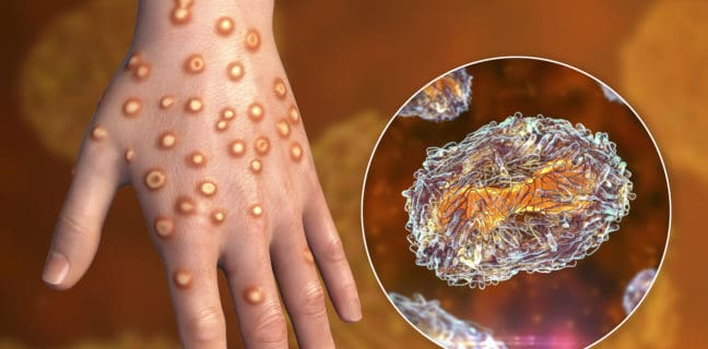Zoonosenerreger mit gebündelten Kräften global bekämpfen! – Europäisches Exzellenznetzwerk tagt im BfR Zoonosene:Hand of a patient with monkeypox infection, 3D illustration. Monkeypox is a zoonotic virus from Poxviridae family, causes monkeypox, a pox-like disease