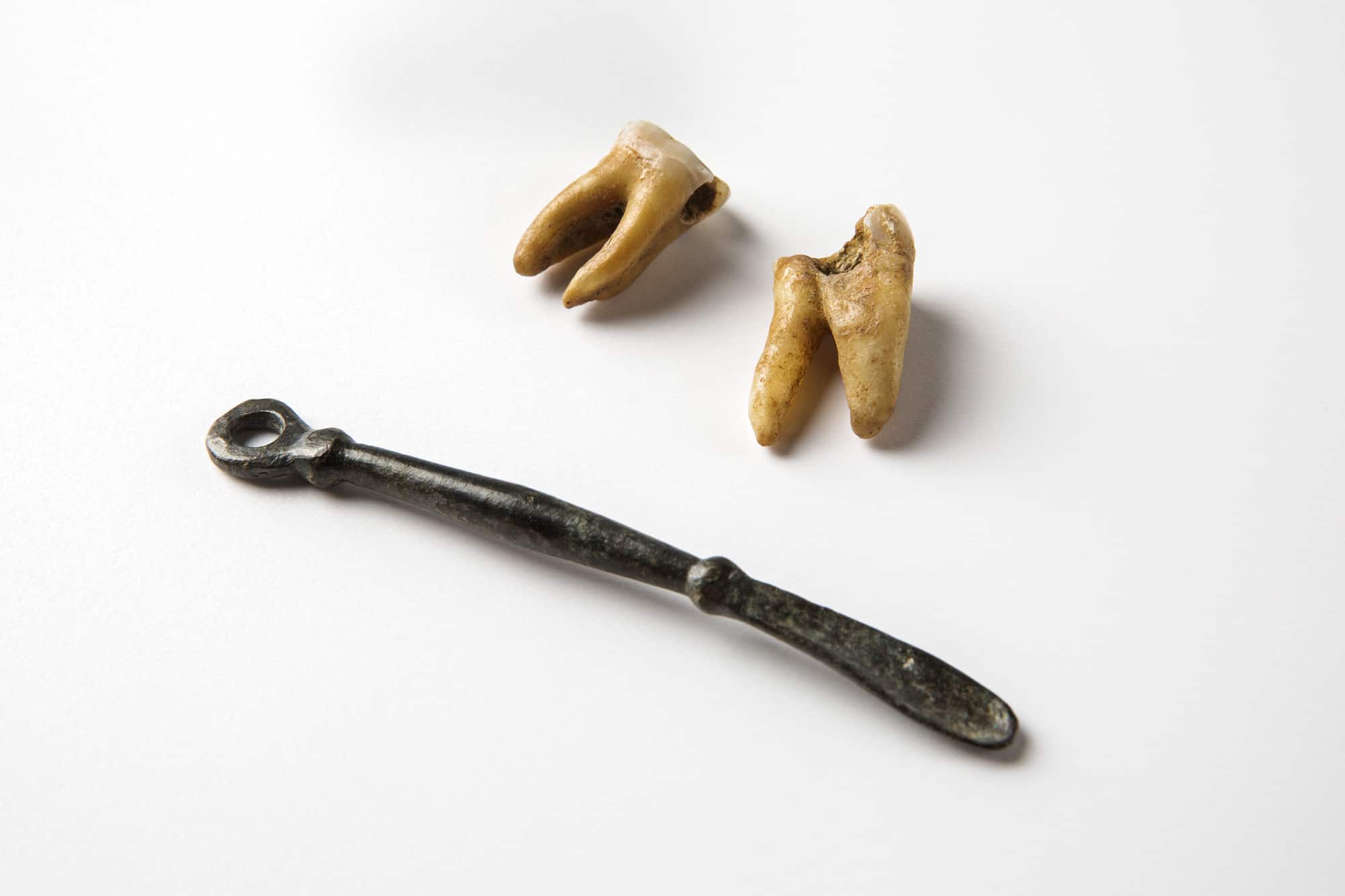 Kariöse Backenzähne und Löffelsonde