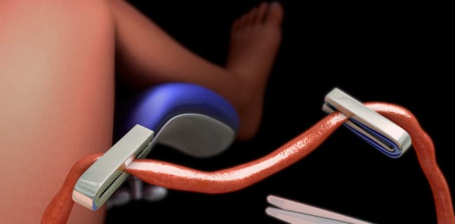 Nabelschnurblut-Banking: Was Eltern wissen müssen newborn umbilical cord cutting