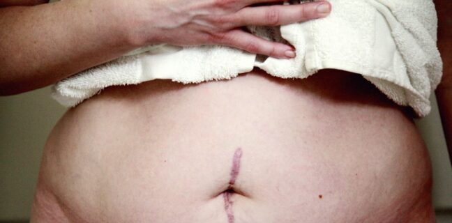 Kaiserschnitt oder normale Geburt: Was ist besser für dich? Photo surgical scar