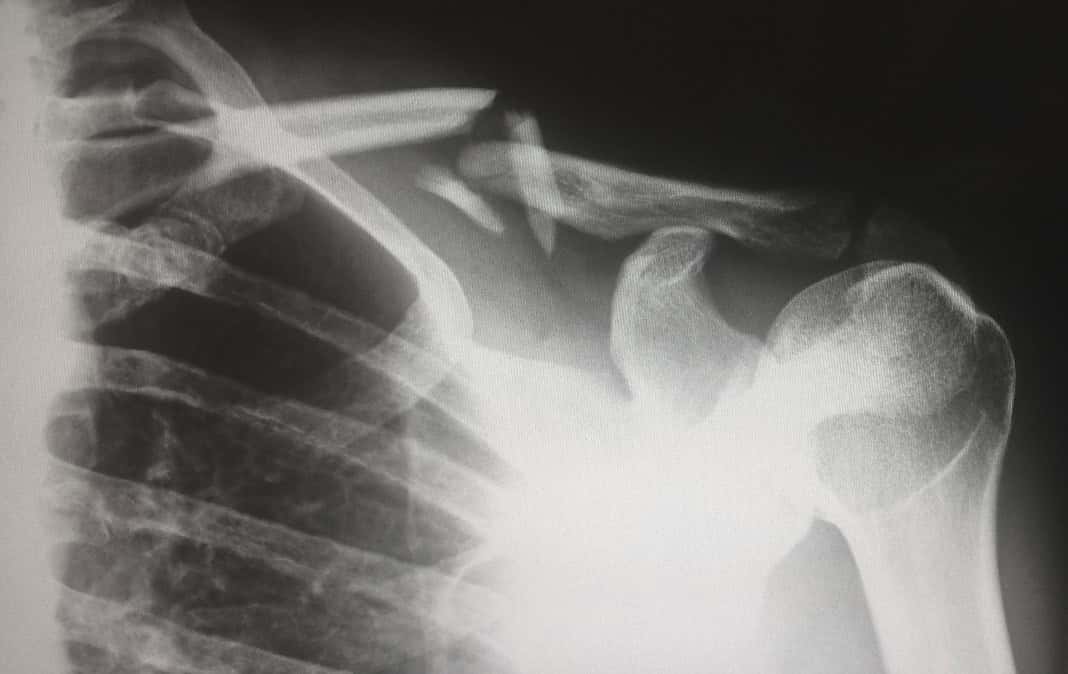 Kalkschulter Homöopathie: Linderung durch natürliche Heilmittel Photo Shoulder pain