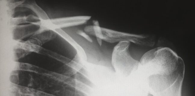 Kalkschulter Homöopathie: Linderung durch natürliche Heilmittel Photo Shoulder pain