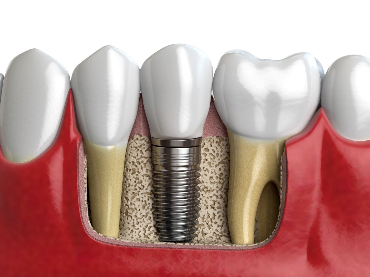 augmentacja kości cena