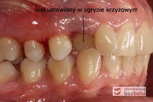 Strona prawa w zwarciu - przerwy między zębami niezbędne do przesunięć Strona prawa w zwarciu - przerwy między zębami niezbędne do przesunięć