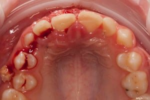 Złamany uśmiech dziecka (7 of 8)