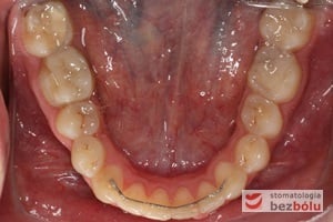 Ksztalt łuku dolnego po leczeniu, widoczne uszeregowanie zębów siecznych oraz retainer stały mający na celu zabezpieczenie zębów przed nawrotem wady