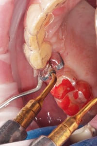 Wstępna preparacja łoża implantu Piezo Surgery