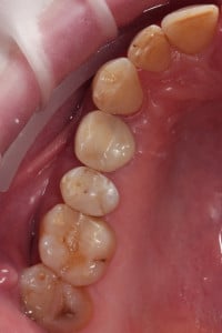 Sytuacja wewnątrzustna po zakńczonym leczeniu