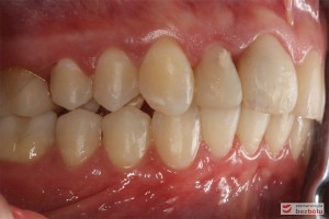 Warunki zgryzowe - strona prawa po zakończonym leczeniu Warunki zgryzowe - strona prawa po zakończonym leczeniu