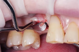 Wprowadzenie implantu