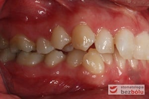 Widok warunków okluzyjnych przed leczeniem od strony prawej