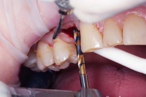 Preparacja łoża implantu