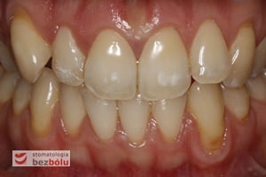 Obraz recesji, której przyczyną jest przedwczesny kontakt okluzyjny Obraz recesji, której przyczyną jest przedwczesny kontakt okluzyjny