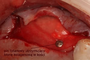 Kolagenowa błona zaporowa chroni regenerowany obszar przed wrastaniem tkanek miękkich oraz wysypaniem granulek biomateriału Kolagenowa błona zaporowa chroni regenerowany obszar przed wrastaniem tkanek miękkich oraz wysypaniem granulek biomateriału