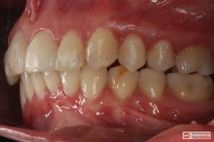 Warunki zgryzowe - strona lewa po zakończonym leczeniu Warunki zgryzowe - strona lewa po zakończonym leczeniu